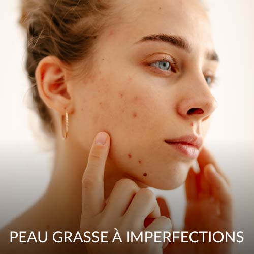 Peau grasse à imperfections