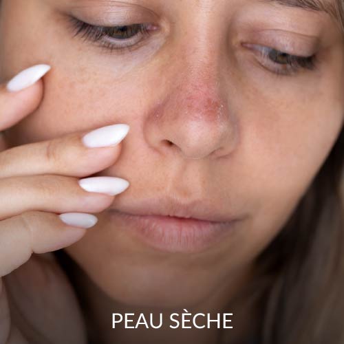 Peau sèche